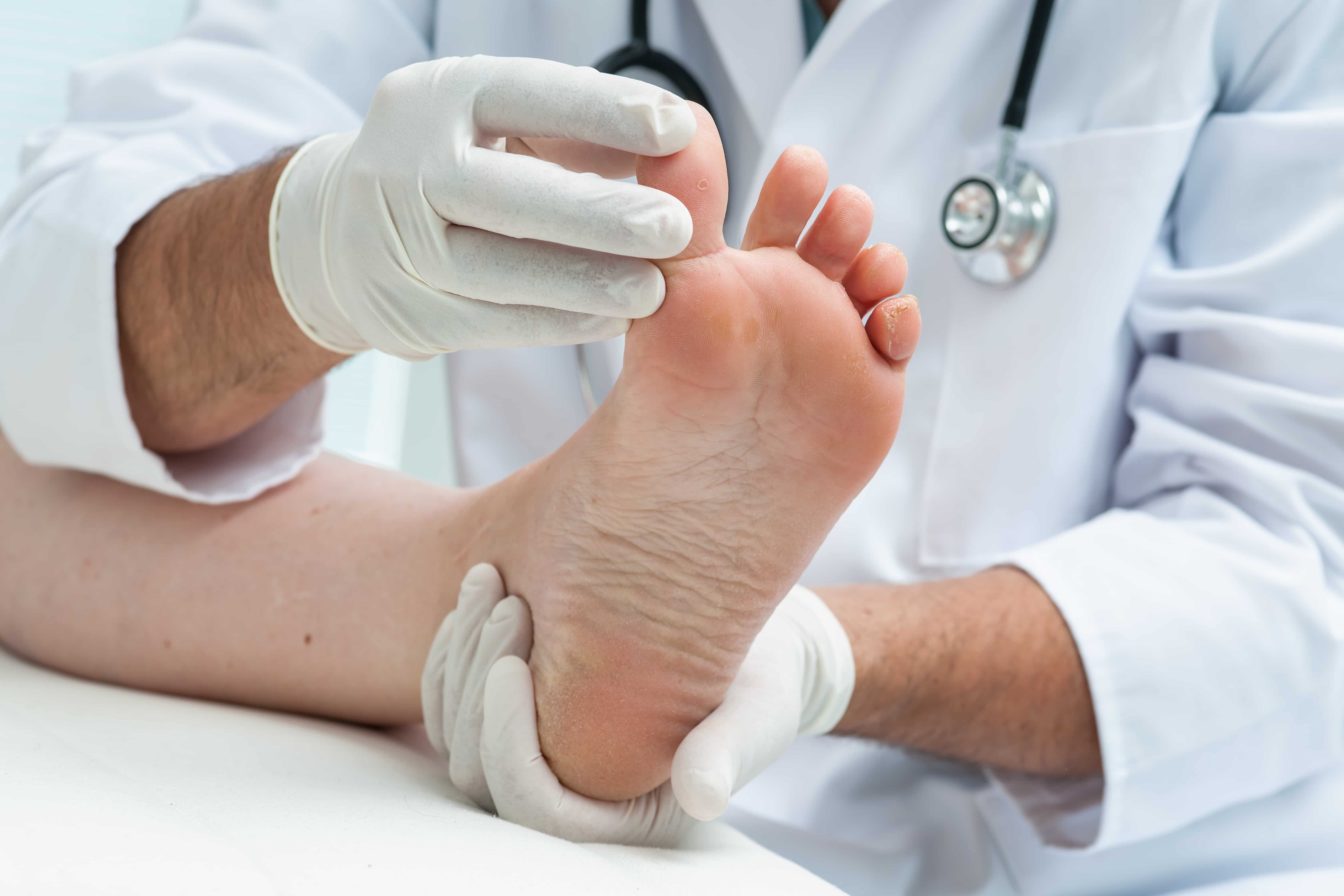Schimmelnagels behandelen