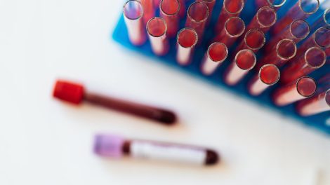 Wat mag je niet eten als je kalium te hoog is